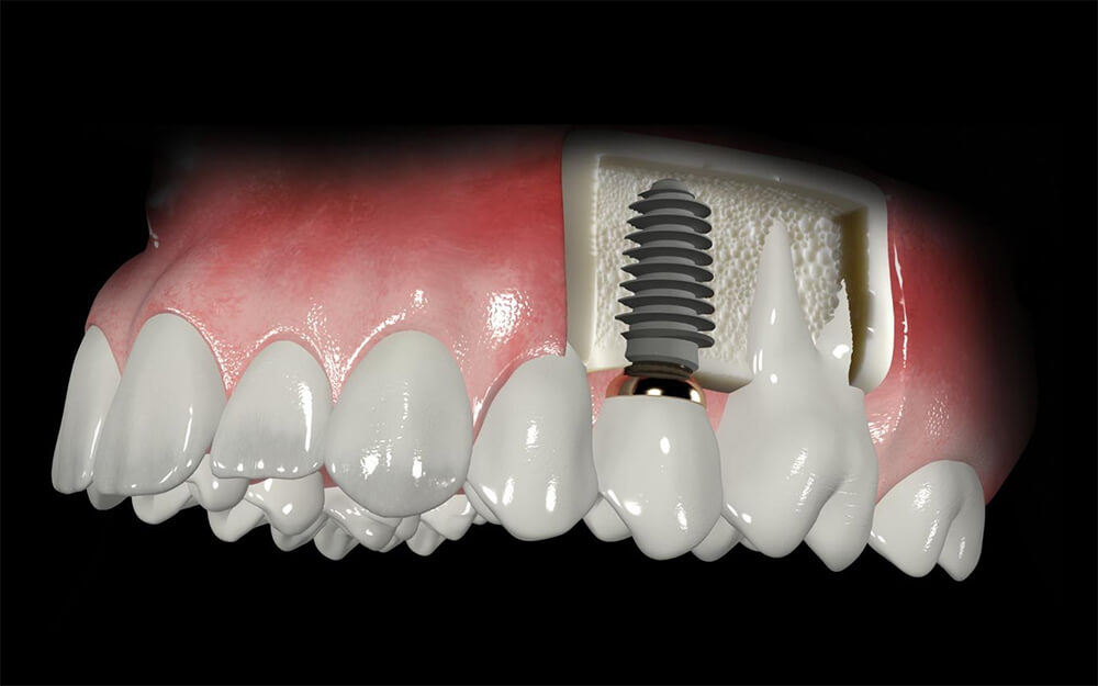 Provisional dientes - DIENTES POSTIZOS PROVISIONALES