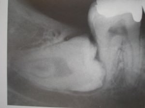Tercer molar inferior en posición horizontal.