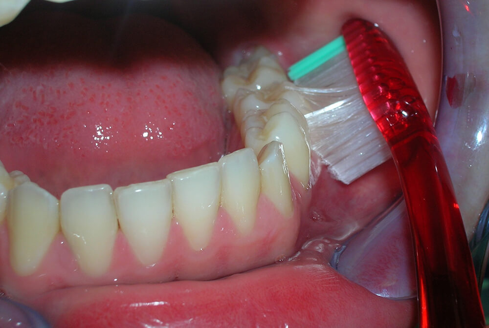 Joyería dental: consejos de expertos para adornar tu sonrisa al