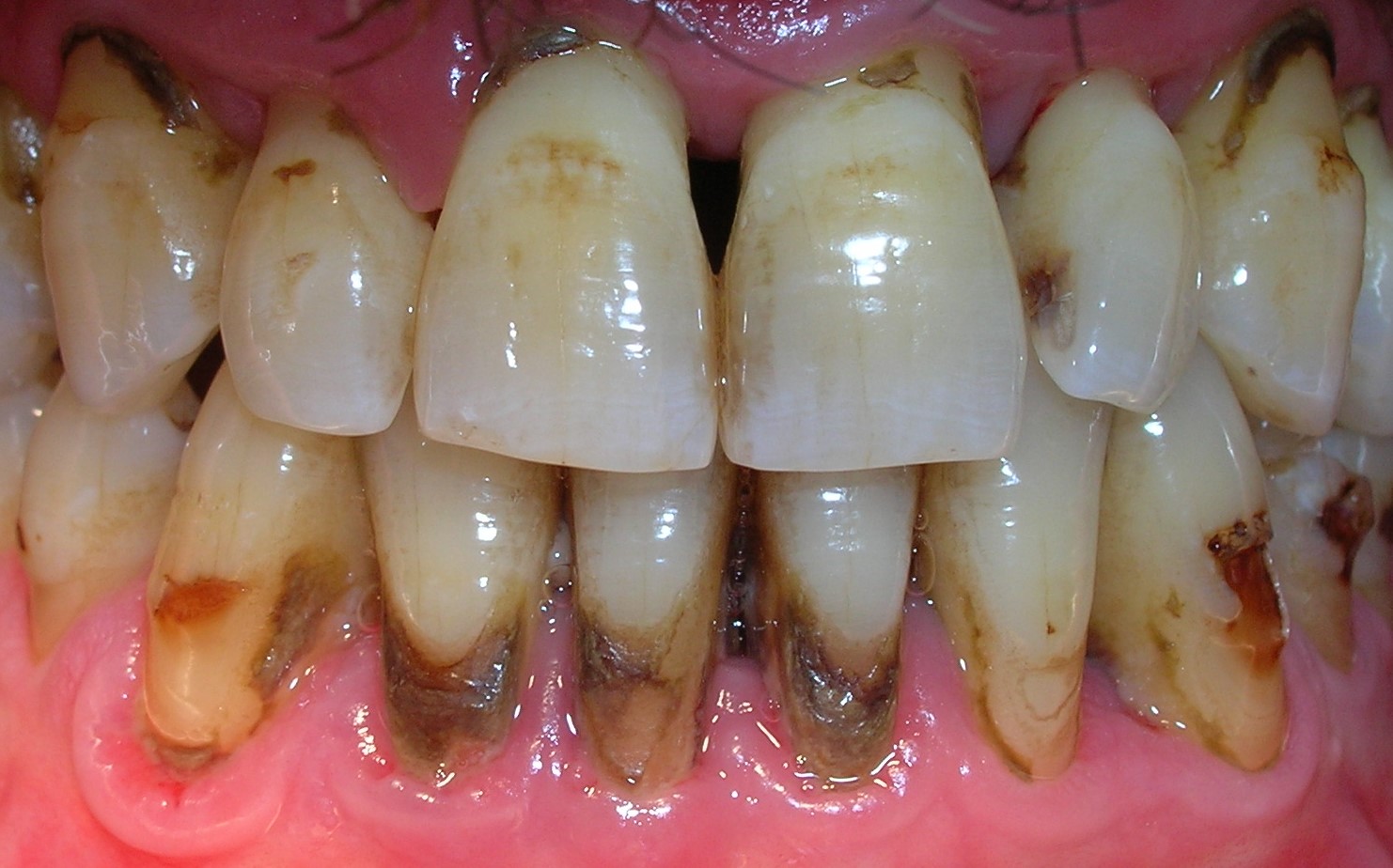 Cálculo dental, el sarro de los dientes 